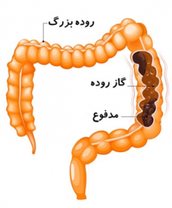علائم-یبوست