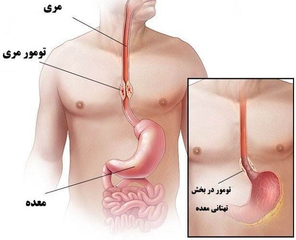 سرطان دستگاه گوارش مری