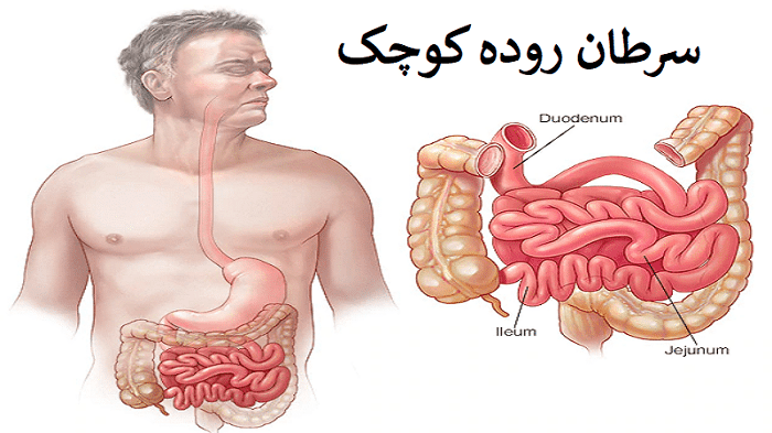 سرطان روده باريك