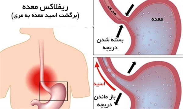 درمان رفلاکس معده