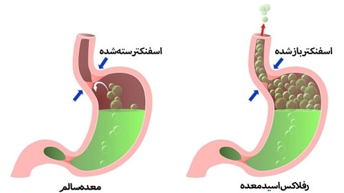علائم رفلاکس معده