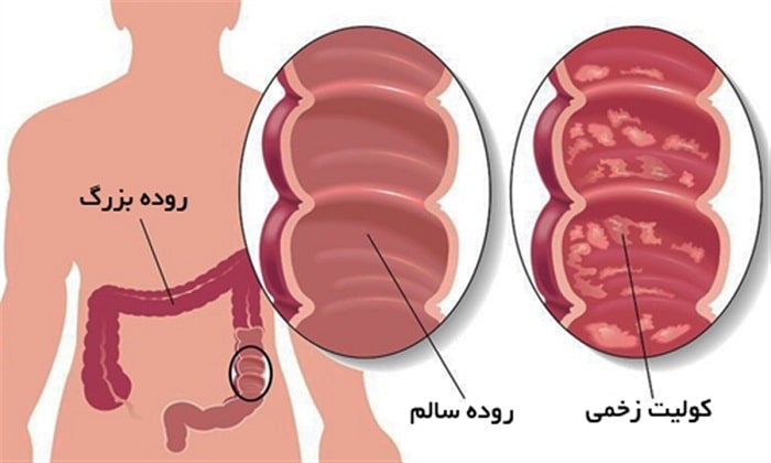 زخم روده