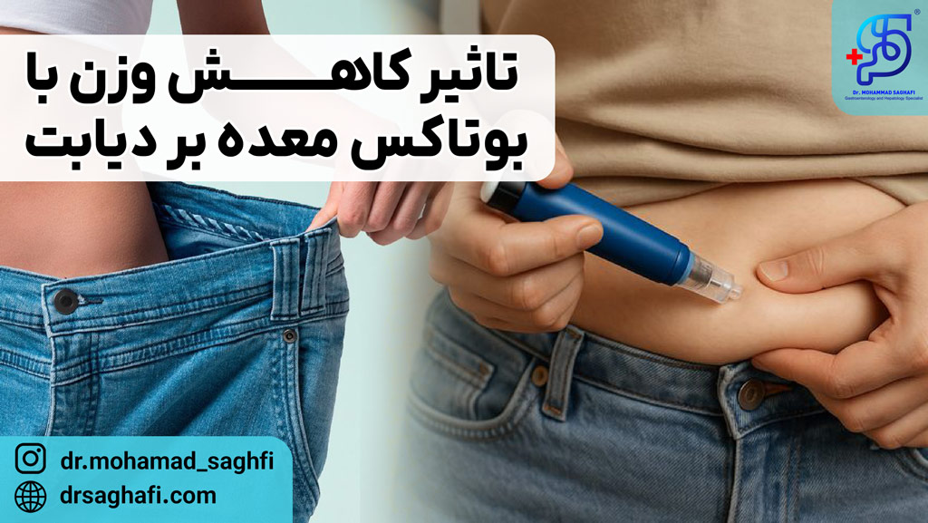 اثر مثبت کاهش وزن با بوتاکس معده بر دیابت