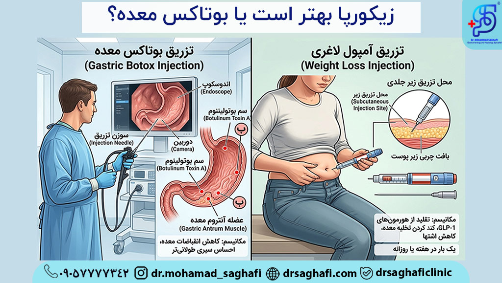 آمپول زیکورپا بهتر است یا بوتاکس معده؟