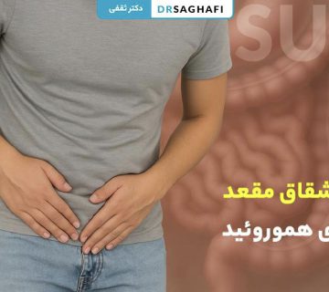 درمان شقاق مقعد و بیماری هموروئید (روش‌های قطعی + هزینه‌ها)