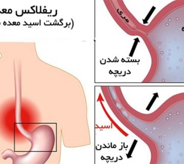 درمان رفلاکس معده
