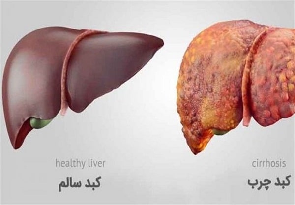 علائم کبد چرب