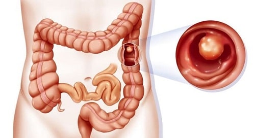 درمان سریع و قطعی التهاب روده