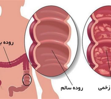 زخم روده