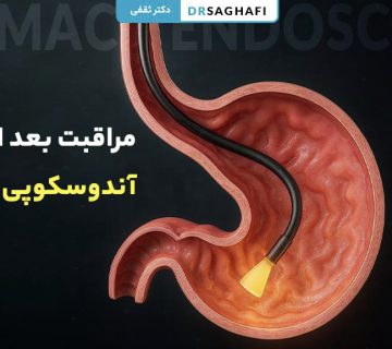 مراقبت بعد از آندوسکوپی معده