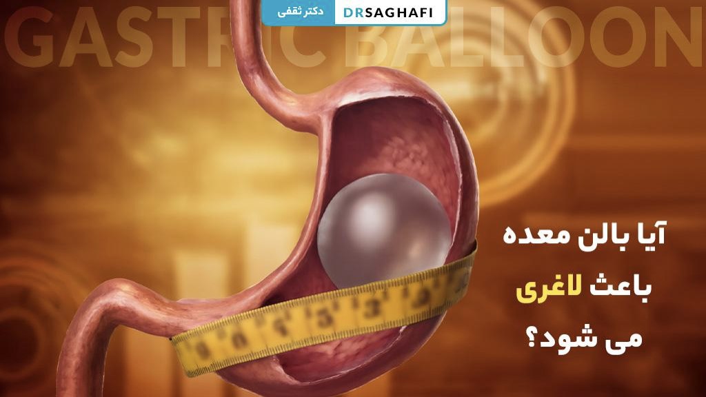 آیا بالن معده باعث لاغری می شود؟