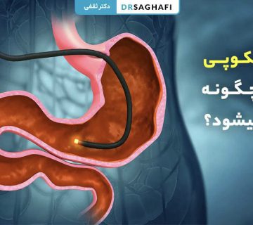 آندوسکوپی معده چگونه انجام می شود؟