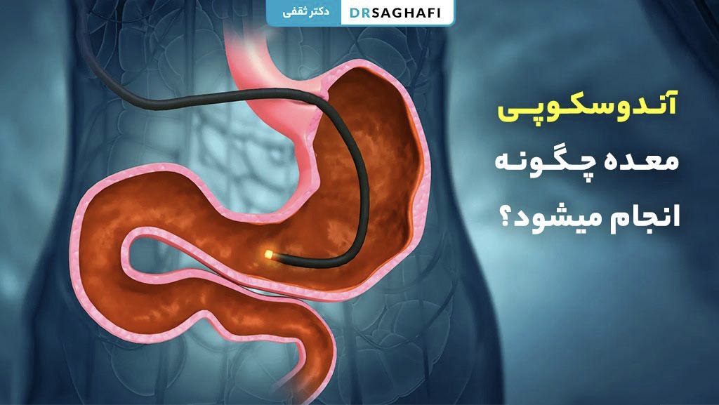 آندوسکوپی معده چگونه انجام می شود؟