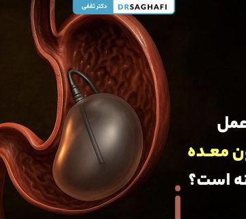 عمل بالون معده چگونه است؟
