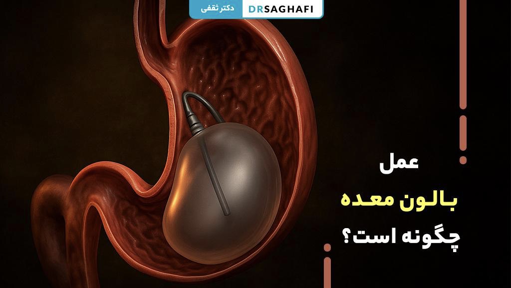 عمل بالون معده چگونه است؟