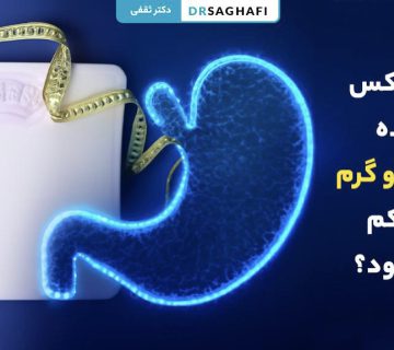 بوتاکس معده چند کیلو گرم وزن کم میکنی