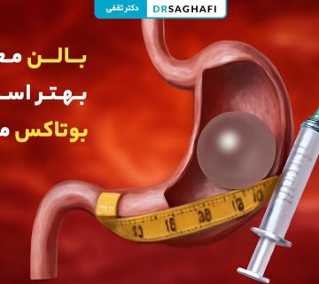 بالن معده بهتر است یا بوتاکس معده؟