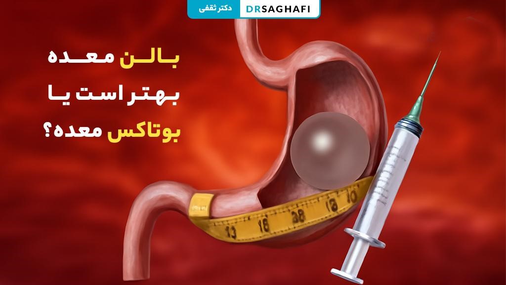 بالن معده بهتر است یا بوتاکس معده؟