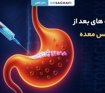 مراقبت های بعد از بوتاکس معده