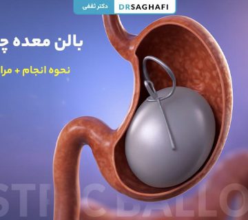 بالن معده چیست؟