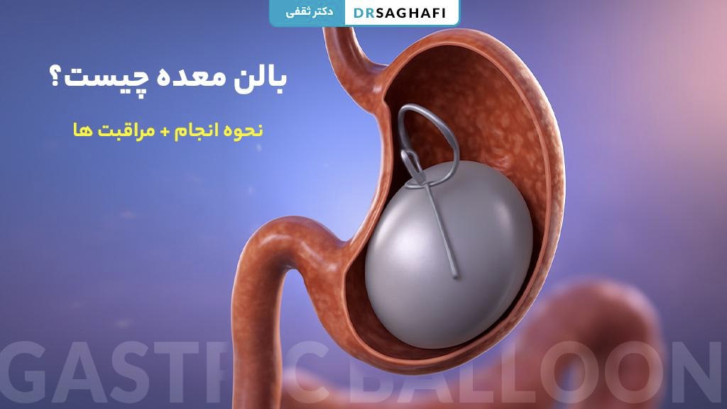 بالن معده چیست؟