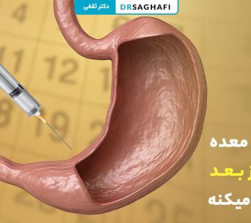بوتاکس معده چند روز بعد اثر میکنه