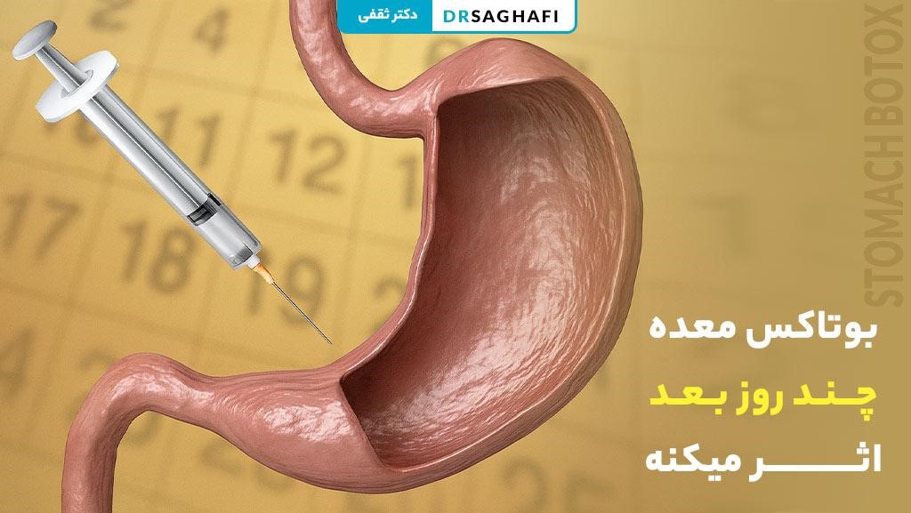 بوتاکس معده چند روز بعد اثر میکنه