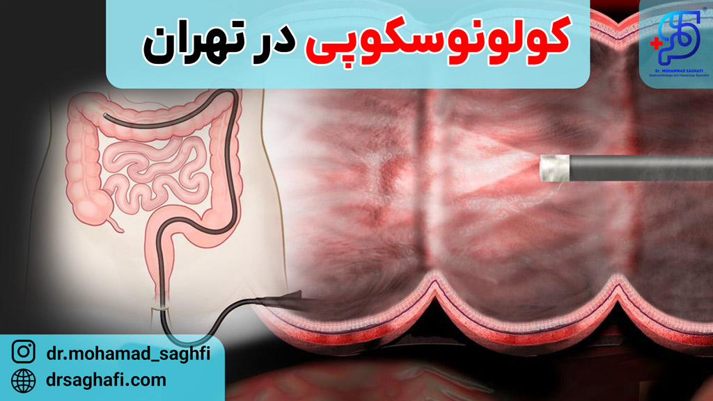 کولونوسکوپی در تهران