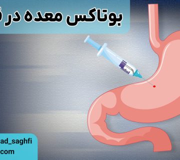 بوتاکس معده در قهلک