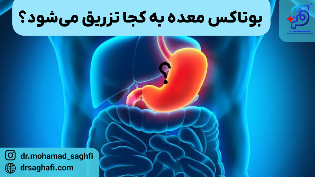 بوتاکس معده به کجا تزریق می‌شود؟