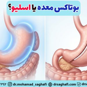 بوتاکس معده بهتر است یا اسلیو؟