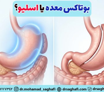 بوتاکس معده بهتر است یا اسلیو؟